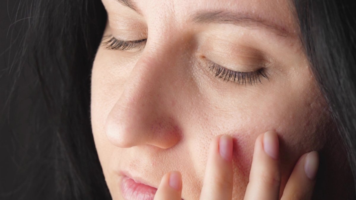 Does Stress Cause Acne? How Stress Triggers Breakouts
