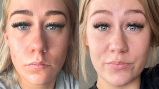 Before and after photos of Chelsea’s acne transformation after personalized acne care from Art of Skin Care.