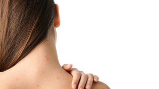 Woman with acne on her back, hand on over her shoulder