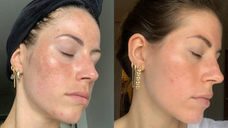 Before and after photo show clear skin on cheek