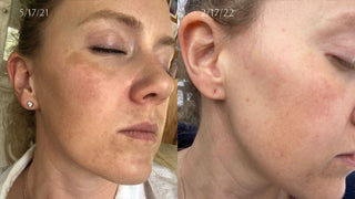 Before and after photos showing even pigmentation