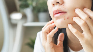 Woman touching breakouts on chin