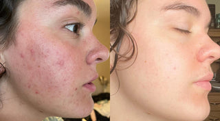 Teenager before and after acne clearing