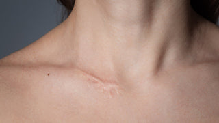 Close up image of scar on collar bone area