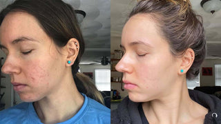 side view of acne clearing before and after