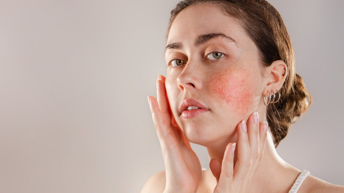 Types of Rosacea: Symptoms, Triggers and Treatments