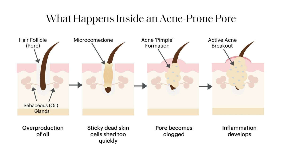 What Causes Acne? The Real Reasons Breakouts Happen
