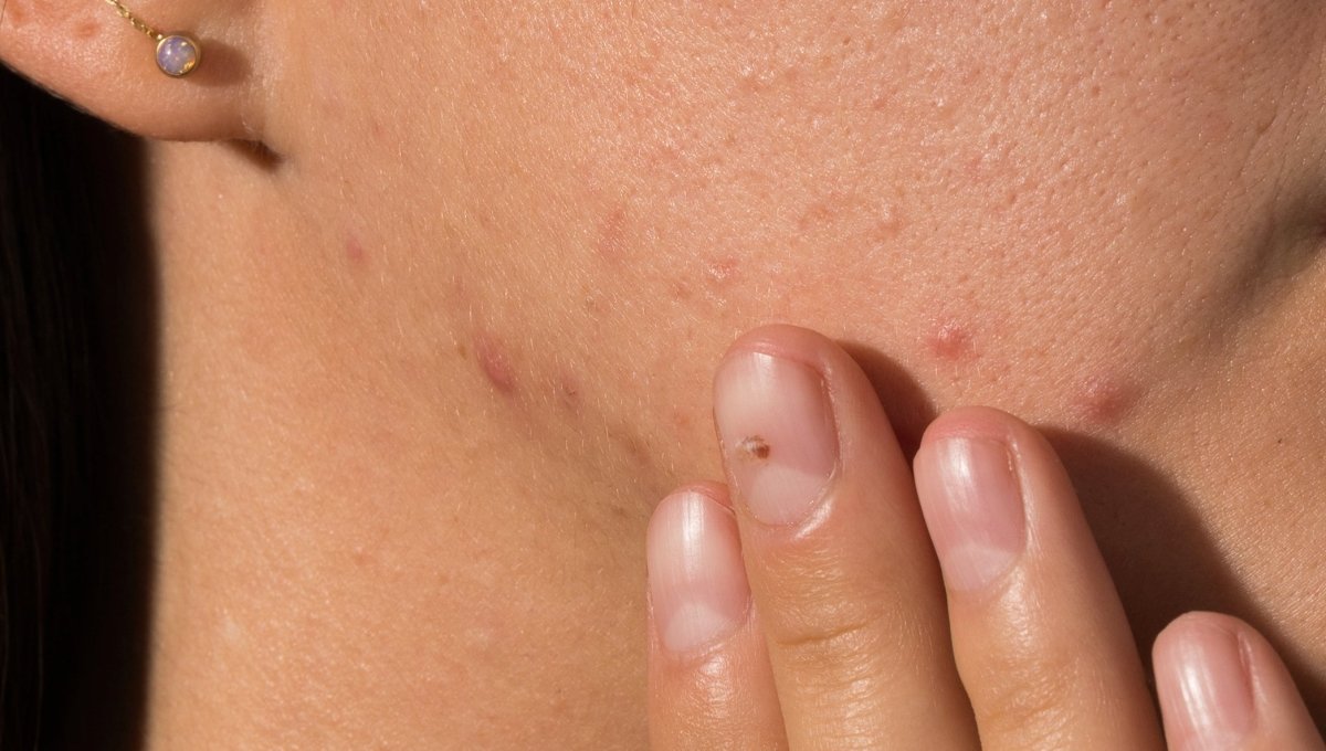 Different Types of Acne and How to Treat Them Effectively – Art of Skin Care, image size:1200x680
