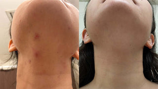 before and after image of acne clearing on jawline and neck