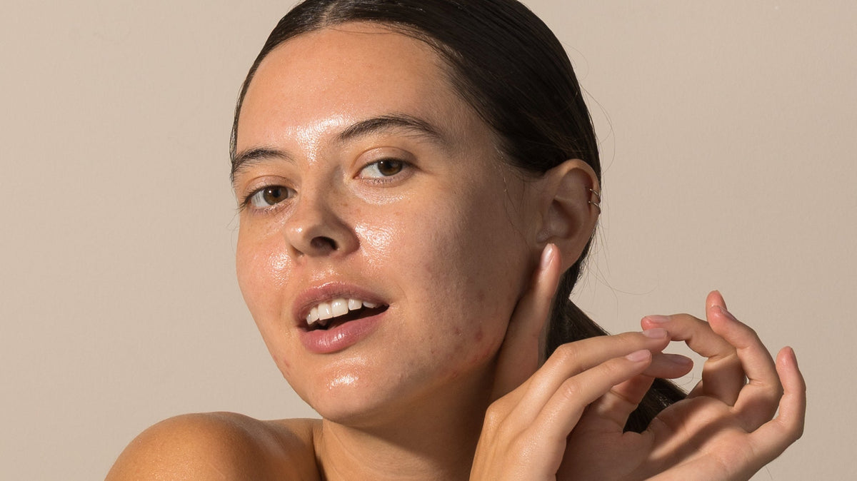 The Ultimate Guide to Acne: Types, Causes, & How to Clear  It