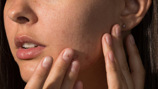 woman with Post Inflammatory Hyperpigmentation (PIH)