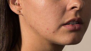 woman with breakouts on her jawline