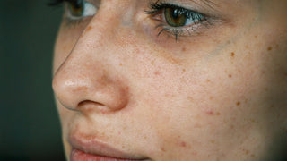 Eye Care Tips for Acne Prone Skin - Art of Skin Care