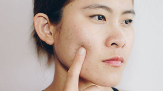 young woman with breakouts pointing to cheek