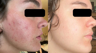 Teenager before and after acne clearing