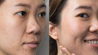 Mindy before and after pictures of clear skin side view.