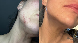 before and after picture of breakouts on the jawline