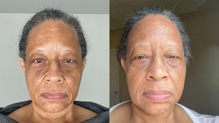 Before & After of woman with hyperpigmentation