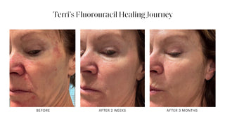 Fluorouracil 5% Irritation Relief: Expert Tips for Healing Your Skin