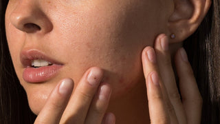 Types of Hyperpigmentation: How To Treat Dark Spots of All Kinds - Art of Skin Care