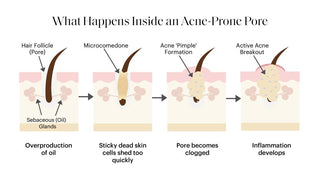 What Causes Acne? The Real Reasons Breakouts Happen - Art of Skin Care