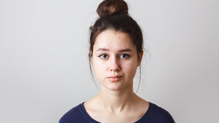 Young woman with acne with a perplexed look on her face