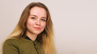 Young woman with acne