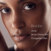 Close-up portrait with text overlay — Circadia Nighttime Control Acne Treatment Lotion is best for acne, acne-prone skin, and congested skin
