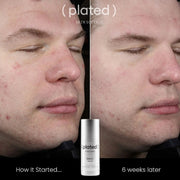 Before and after comparison showing skin improvement after 6 weeks of using Plated Skin Science DAILY Serum, with visibly reduced redness and blemishes