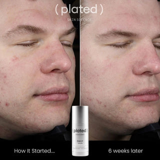Before and after comparison showing skin improvement after 6 weeks of using Plated Skin Science DAILY Serum, with visibly reduced redness and blemishes