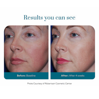 Colorescience Barrier Pro Serum Spray before and after comparison showing improved skin tone, reduced blotchiness and enhanced radiance after 4 weeks of use, courtesy of Robertson Cosmetic Center