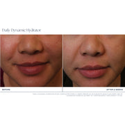 Clinical before and after close-up photos showing more even skin tone and reduced redness around the nose and mouth area after 2 weeks of iS Clinical Daily Dynamic Hydrator use