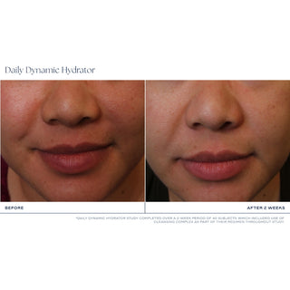 Clinical before and after close-up photos showing more even skin tone and reduced redness around the nose and mouth area after 2 weeks of iS Clinical Daily Dynamic Hydrator use