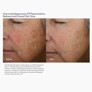 Before and after photos showing improved pigmentation, redness, and skin tone