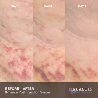 Day 1 to Day 8 photos showing neck bruising fading with INhance Post-Injection Serum
