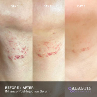 Day 1 to Day 3 photos showing injection site redness fading with INhance Serum