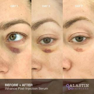 Day 1 to Day 7 photos showing under-eye bruise fading with INhance Post-Injection Serum