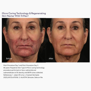 Before and after face photos showing skin recovery after micro coring with Skin Nectar