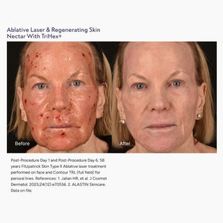 Before and after face photos showing skin healing after ablative laser with Skin Nectar
