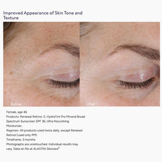 Before and after eye area photos showing improved skin tone and texture