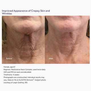 Before and after neck photos showing improved crepey skin and wrinkles