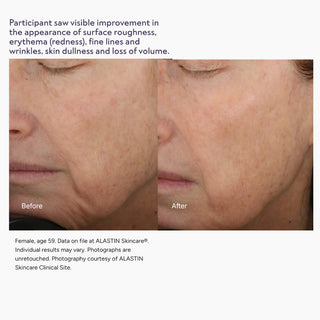 Before and after photos showing improved skin roughness, redness, and volume