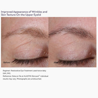 Before and after ALASTIN Restorative Eye Complex showing smoother upper eyelid wrinkles and improved skin texture