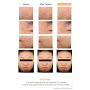 Azulene Relief Solution Ampoule before and after results - visible skin clarity improvement after 2 and 4 weeks of use on acne-prone skin