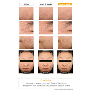 Azulene Relief Solution Ampoule before and after results - visible skin clarity improvement after 2 and 4 weeks of use on acne-prone skin