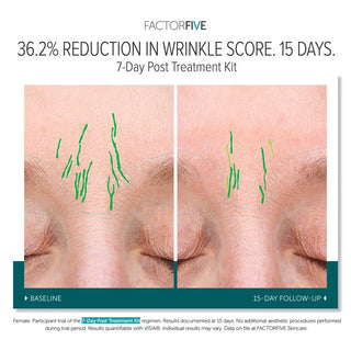 FACTORFIVE 7-Day Post Treatment Kit before and after: 36.2% reduction in frown line wrinkle score after 15 days