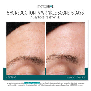 FACTORFIVE 7-Day Post Treatment Kit before and after: 57% reduction in forehead wrinkle score after 6 days
