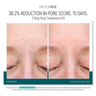 FACTORFIVE 7-Day Post Treatment Kit before and after: 38.2% reduction in VISIA pore score between brows after 15 days