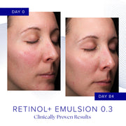 Clinical before and after photos showing reduced redness and improved skin clarity after 84 days of iS Clinical Retinol+ Emulsion 0.3 use, clinically proven results