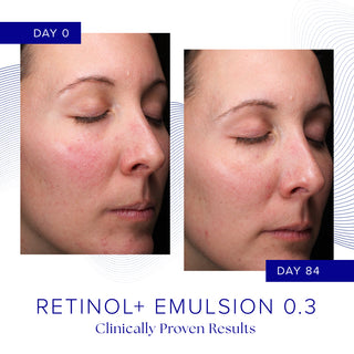 Clinical before and after photos showing reduced redness and improved skin clarity after 84 days of iS Clinical Retinol+ Emulsion 0.3 use, clinically proven results